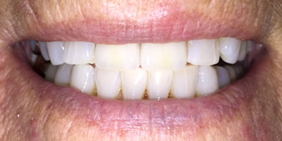Smile after closing the small gap between the two front teeth