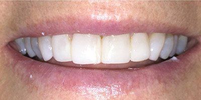 Smile after treating plaque stains on the teeth