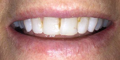Smile with plaque stains on multiple teeth