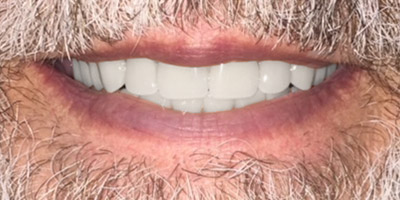 Smile with white, evenly spaced teeth