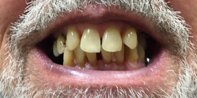 Smile with yellowed and gapped teeth