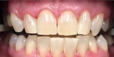 Mouth after whitening the teeth