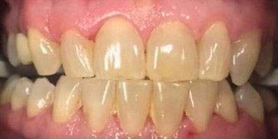 Mouth with yellowed teeth