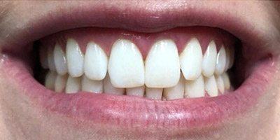 Smile after treating yellow discoloration on all of the teeth