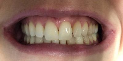 Smile with yellow discoloration on all of the teeth