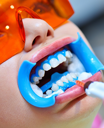 Dental patient getting their teeth whitened