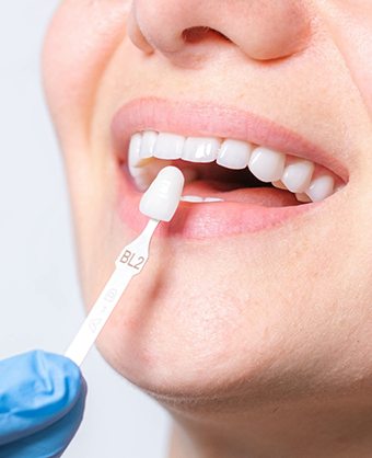 Shade guide held up to a smile