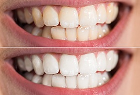 Closeup smile before and after teeth whitening