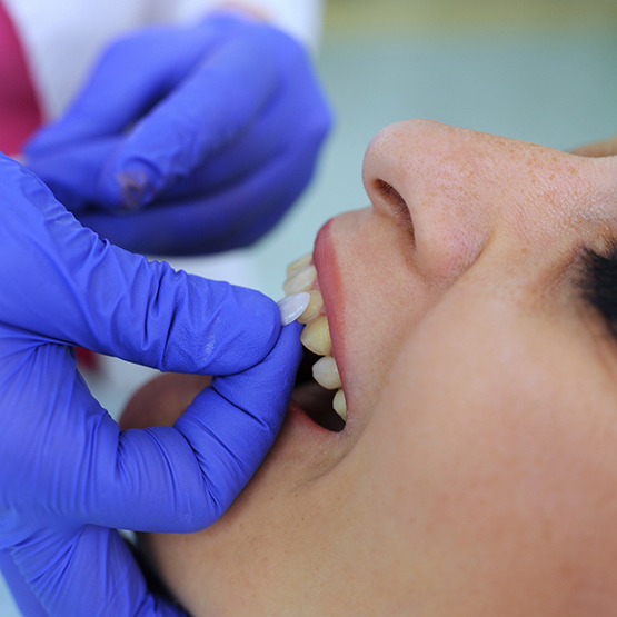 Dentist placing a veneer over a patient's tooth